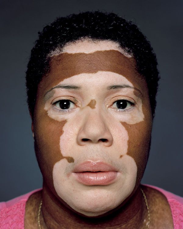 vitiligo treatment in india