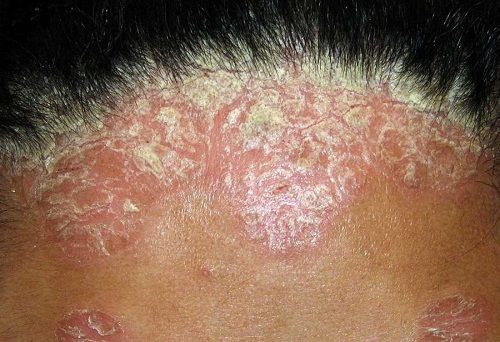 psoriasis pictures - 1
