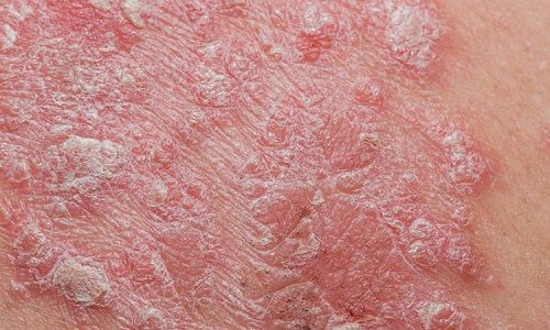 psoriasis pictures - 2