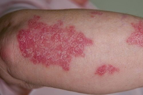 psoriasis pictures - 3