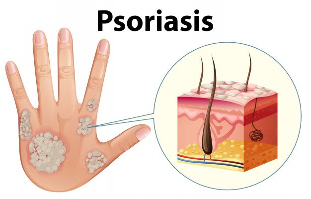 All You Want To Know About Psoriasis – Symptoms, Pictures & Medication