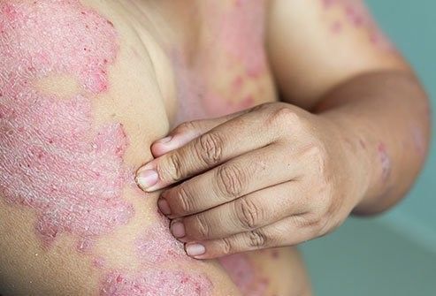 psoriasis pictures