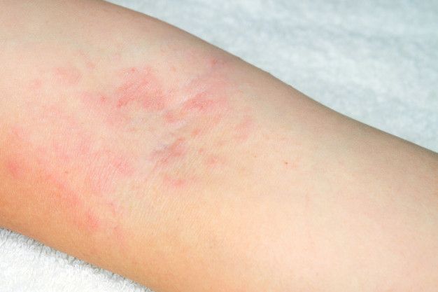 psoriasis pictures