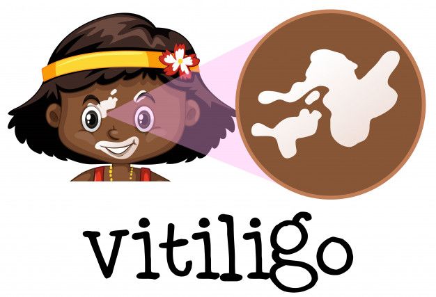 Best Vitiligo Treatment Cream in India | Vitiligo Treatment at Home
