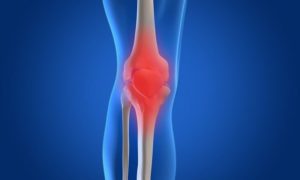 How to Manage Pain Swelling and Bruising After Total Knee Replacement