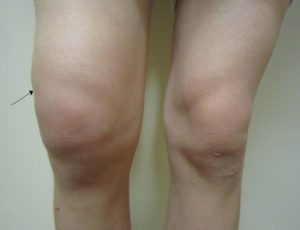 pictures of swelling after knee replacement