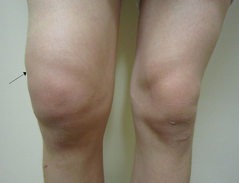 Pictures Of Swelling After Knee Replacement 