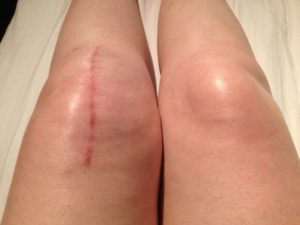 sharp pain after knee replacement