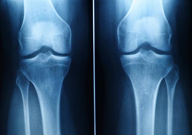Arthritis in Knee Cap