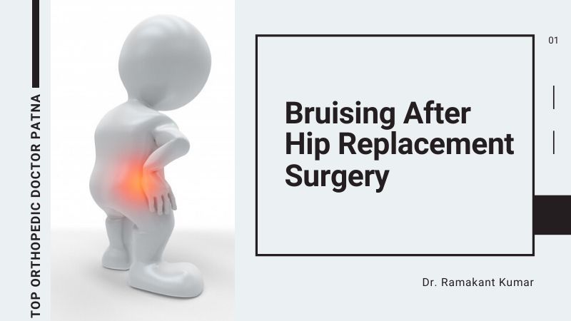 Bruising After Hip Replacement Surgery