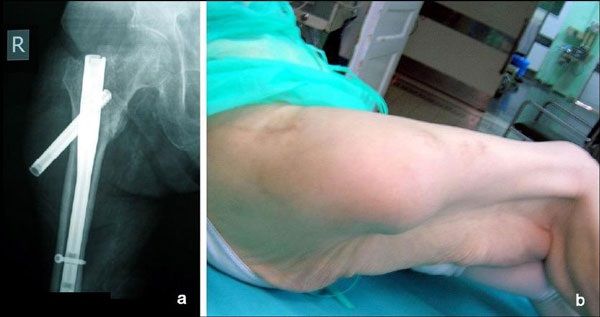 Pictures of Swelling after Knee Replacement