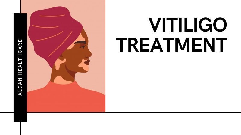 Melacyn – Proven Best Derma Solution for Vitiligo Treatment in India