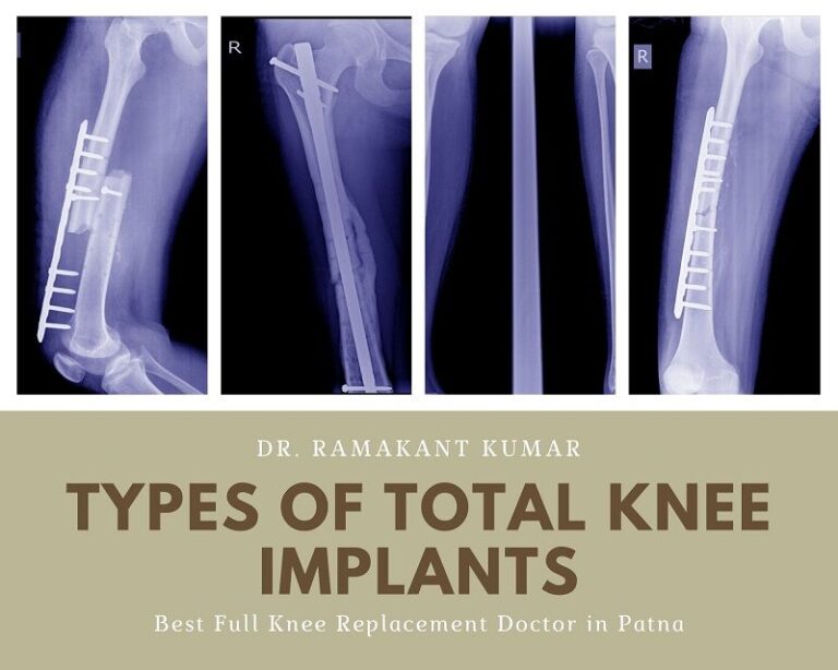 Types Of Total Knee Implants Best Knee Replacement Implant In India