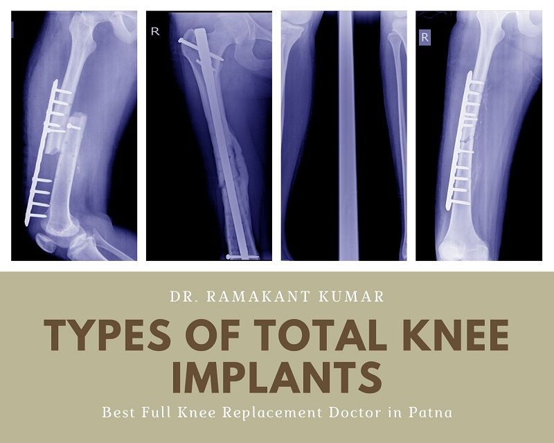 types of total knee implants