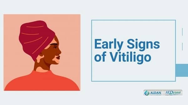 Early Signs of Vitiligo - Splash