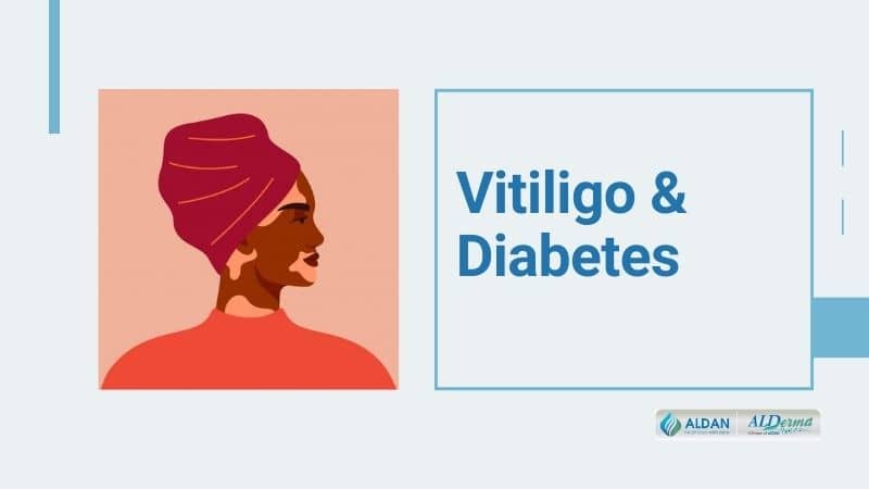 Vitiligo and Diabetes: Here Know the Relation