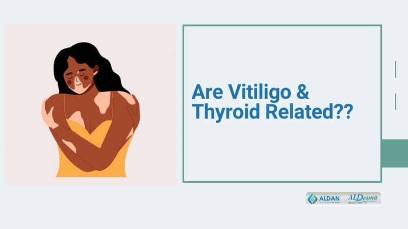 Are Vitiligo and Thyroid Related | Vitiligo Treatment