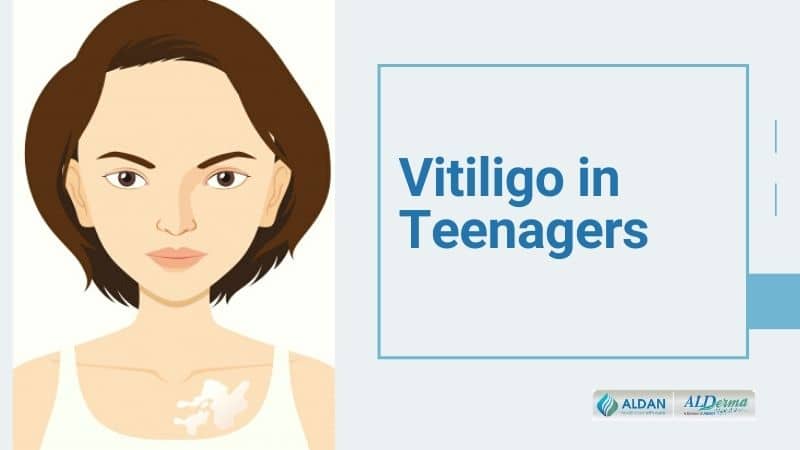 Vitiligo in Teenagers | How to Prevent Vitiligo