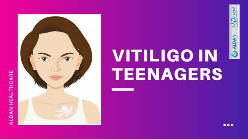 VITILIGO IN TEENAGERS