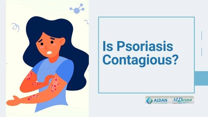 Is Psoriasis Contagious?