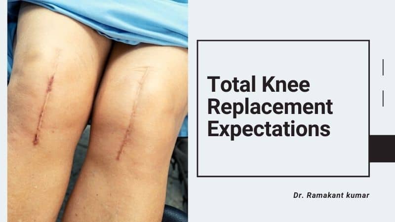 Total Knee Replacement Expectations