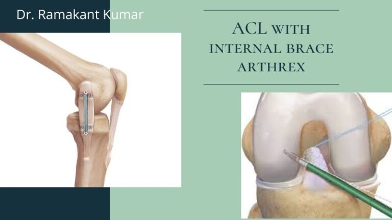 ACL With Internal Brace Arthrex Internal Brace ACL Repair 