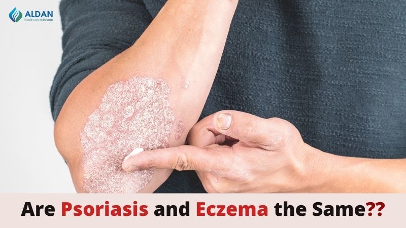 Skin Conditions: Are Psoriasis and Eczema the same?