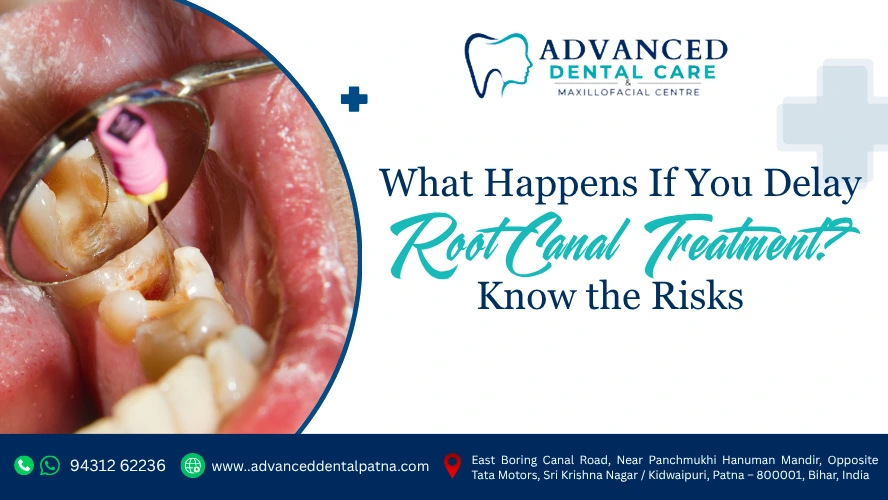 What Happens If You Delay Root Canal Treatment?