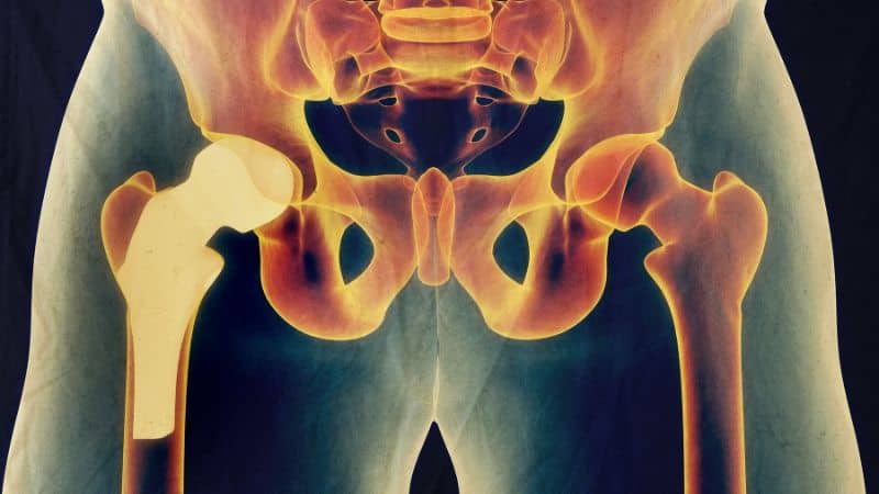 Everything You Need to Know About Hip Replacement Surgery