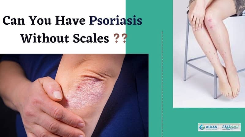 Want to Know more about Scaly or Non-Scaly Psoriasis? Know Here….