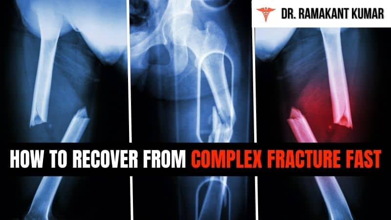 6 Tips to Recover from Complex Fracture Fast