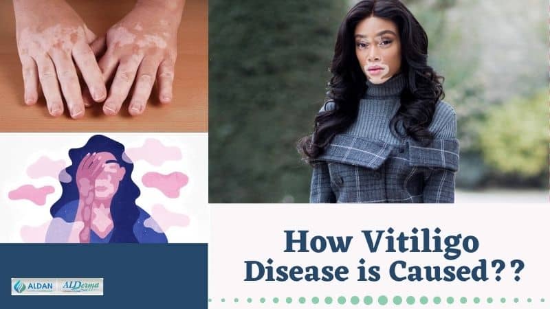 How Vitiligo Disease Is Caused ” Symptoms Of Vitiligo “