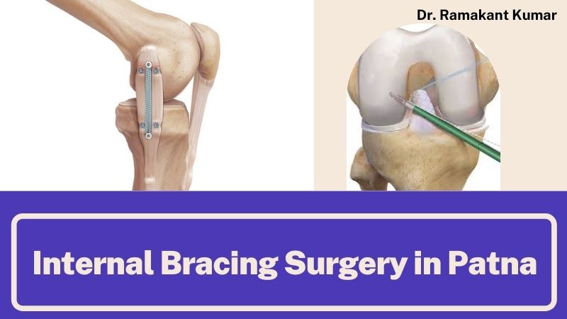 Internal Bracing Surgery: Overview on its Benefits, Needs and Treatments