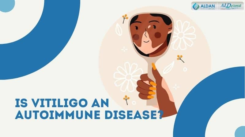 Is Vitiligo an Autoimmune Disease? (Find Facts Here…)