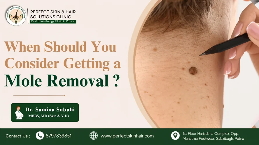 When Should You Consider Getting a Mole Removal Treatment in Patna?