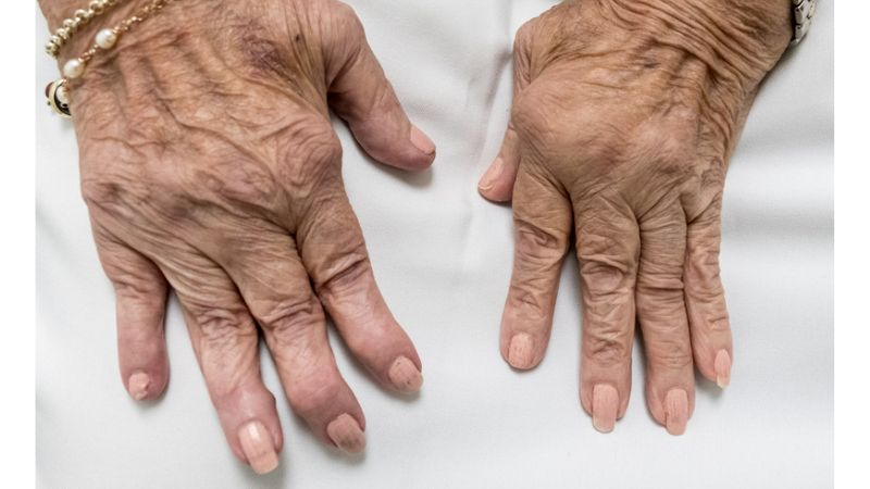 Rheumatoid Arthritis: Everything You Should Know