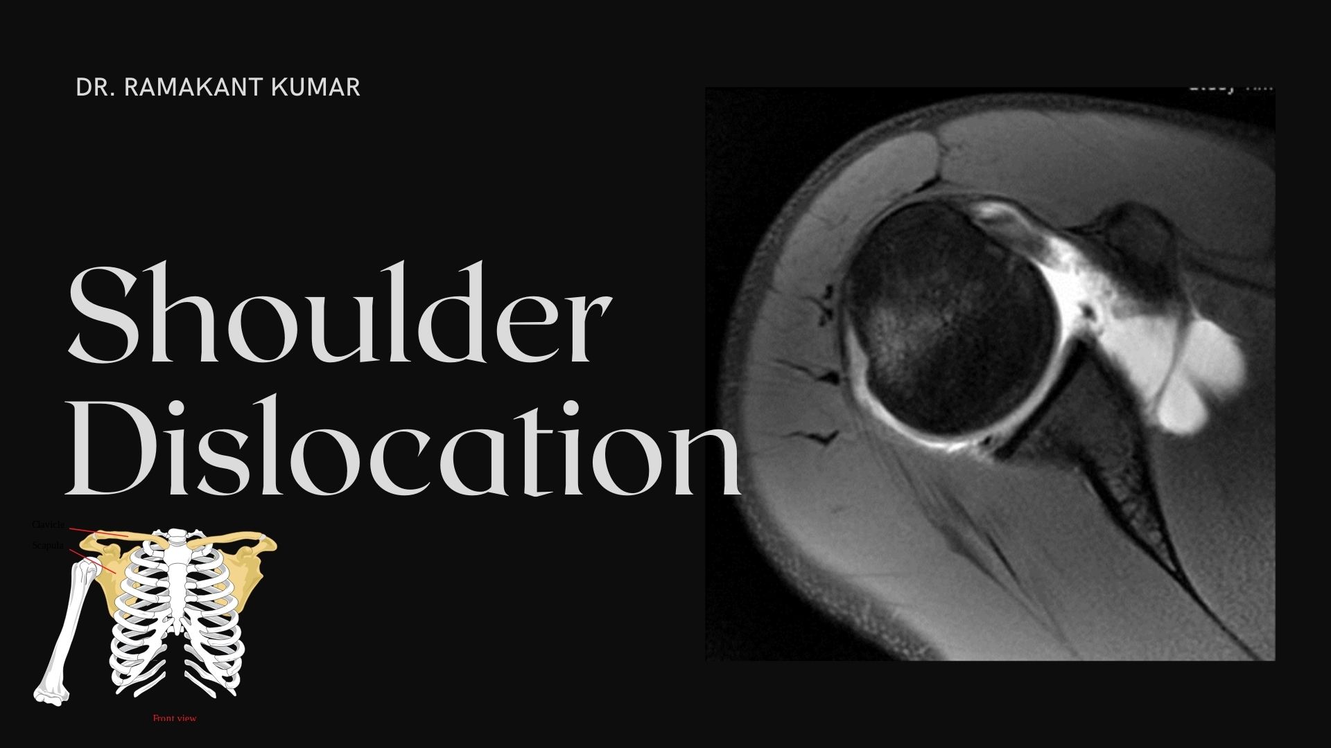 Shoulder Dislocation Treatment - Dislocated Shoulder Recovery