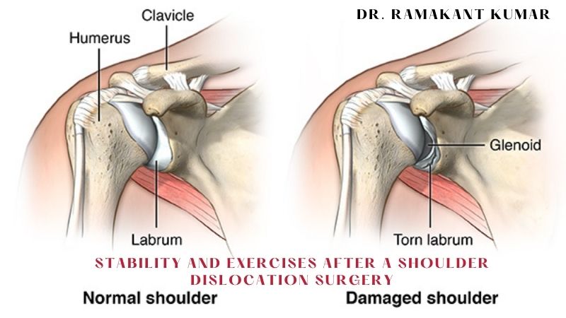 Stability and Exercises After a Shoulder Dislocation Surgery