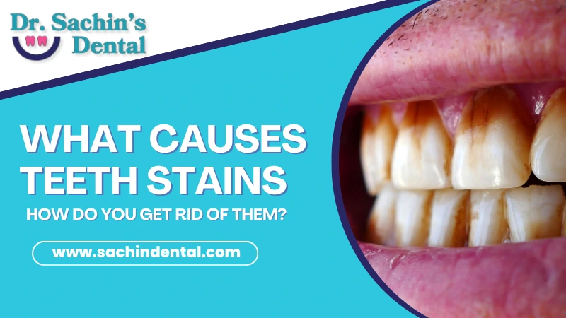 What Causes Stains on the Teeth? Treatments & Lifestyle Changes