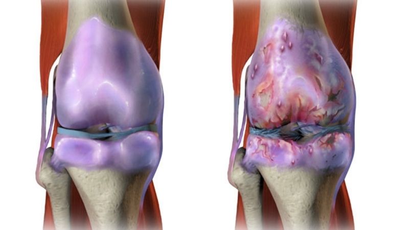 Where Does Osteoarthritis Commonly Occur?
