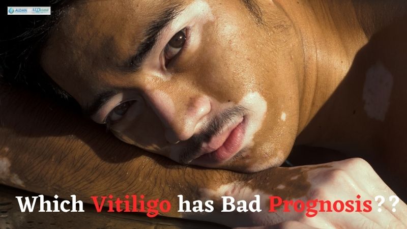 Which Vitiligo Has Bad Prognosis?? Know In the Full Blog Here!