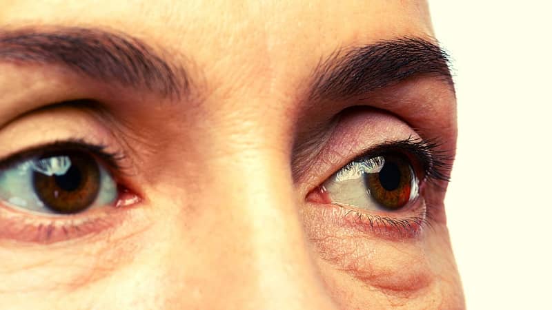 9 Causes of Bags Under Eyes – How to Treat Naturally? (Remedies)