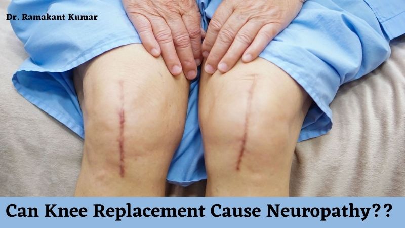 Can Knee Replacement Cause Neuropathy Know Here 