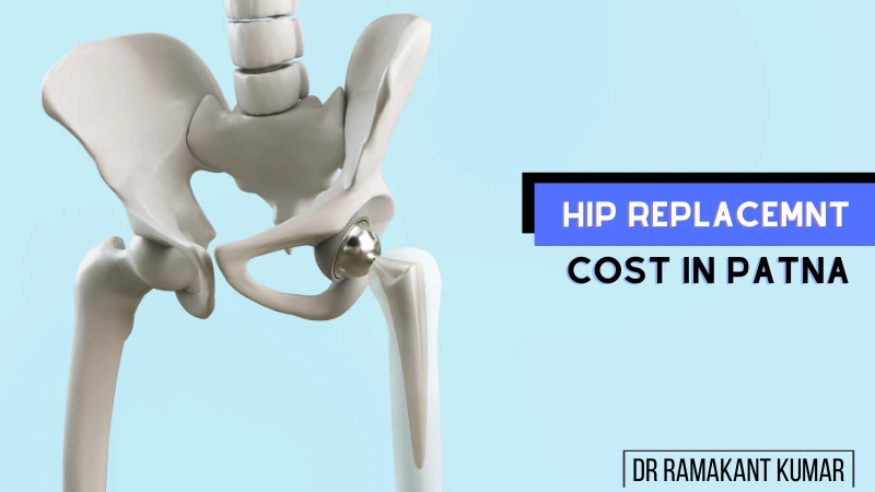 hip replacement surgery cost in Patna