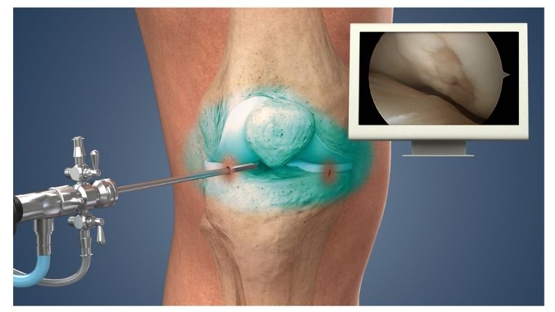 what is the recovery time for arthroscopic meniscus repair